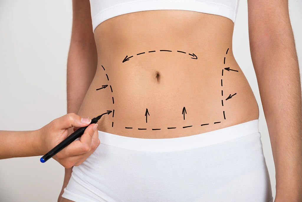 Liposuction Surgery in Kenya