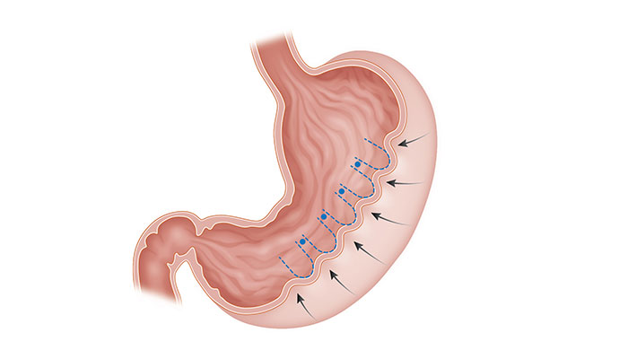 allurion gastric balloon treatments in nairobi