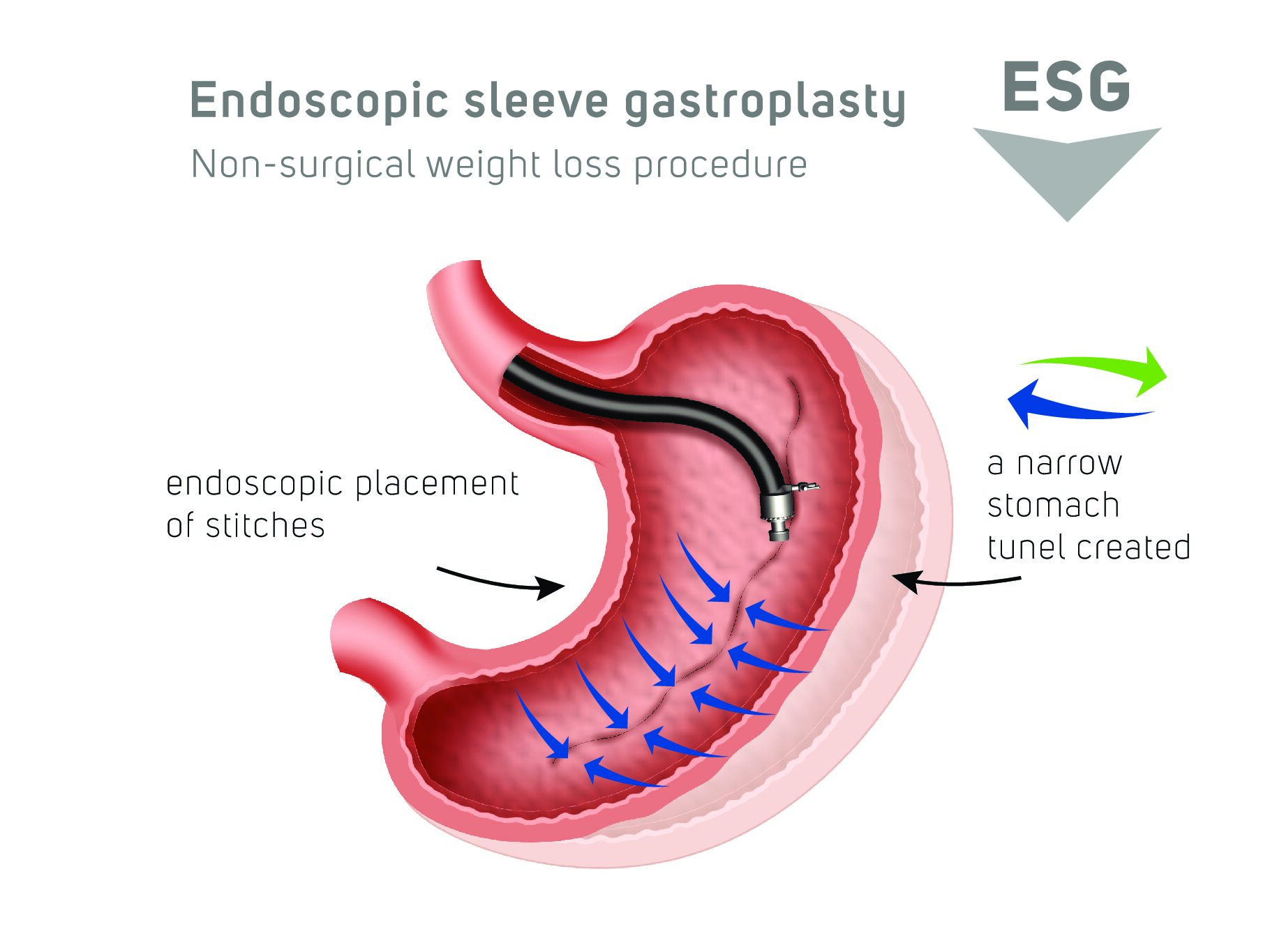 allurion gastric ballon services in kenya